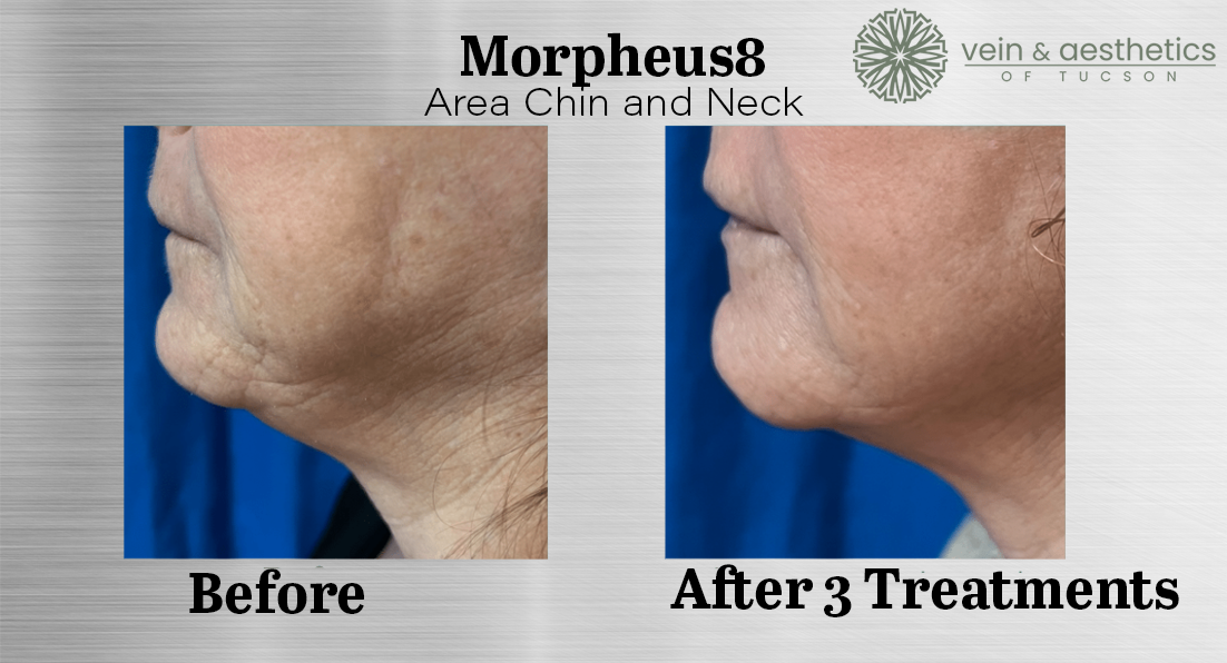 chin neck